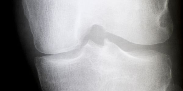 Röntgenbild von Arthrose