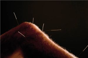 Knie mit Akupunkturnadeln